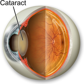 Cataract image RJK Optometry Coffs Harbour Optometrists