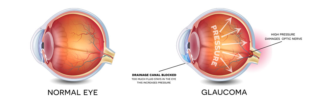 glaucoma-image RJK Optometry Coffs Harbour Optometrists