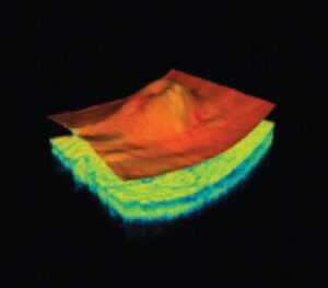 tomography at RJK optometry coffs harbour